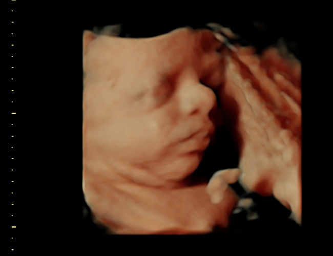 3D ultrasound image at 31 weeks